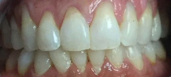 Close up of person smiling before getting a dental veneer repaired