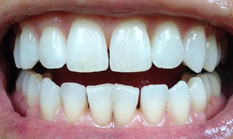 Close up of bright smile after teeth whitening treatment