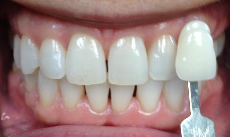 Close up of teeth with dentist holding shade guide in front of them