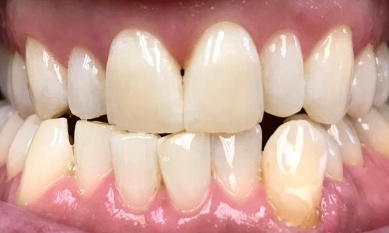 Close up of smile with brighter teeth after cosmetic dental treatment