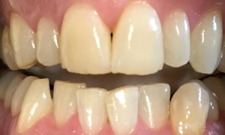 Close up of smile with discolored teeth