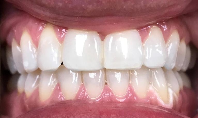 Full set of white teeth after cosmetic dental treatment