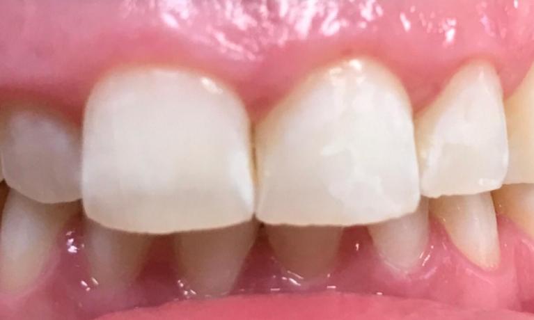 Zoomed in view of a person with white teeth