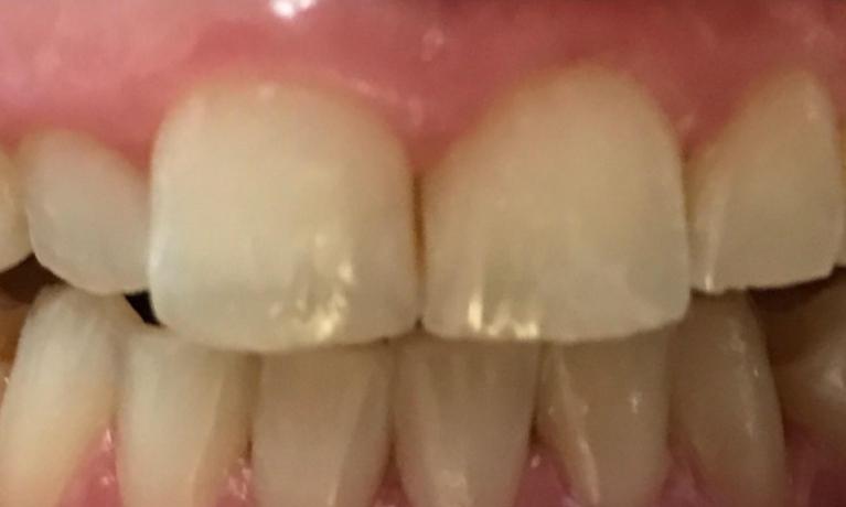Zoomed in view of a person with yellow teeth