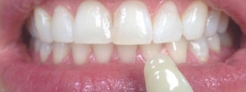 Shade guide next to a smile with whiter teeth