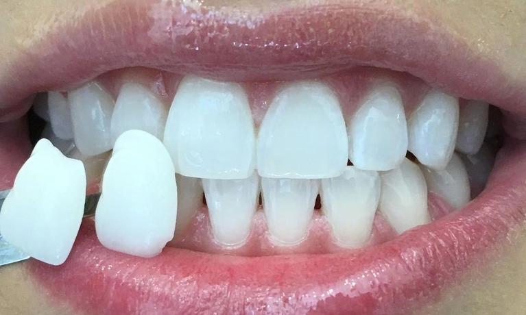 Close up of a shade guide next to a person with whitened teeth