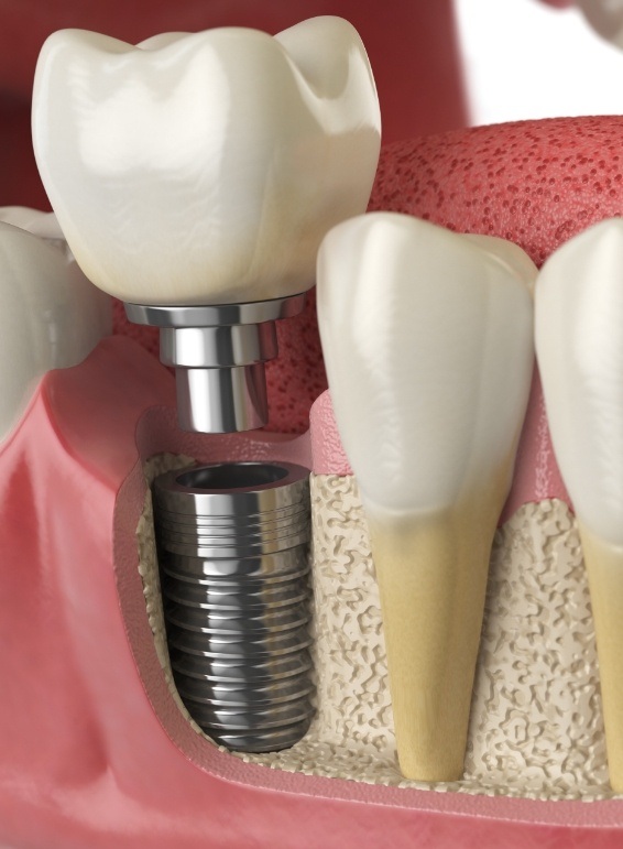 Animated dental implant being placed in the lower jaw