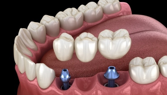 Two animated dental implants supporting a dental bridge and replacing three missing teeth