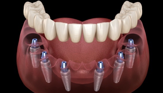 Six animated dental implants supporting a full denture