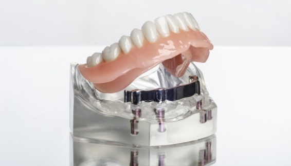 Model of All on 4 dental implants