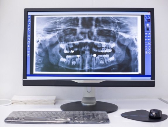 Digital dental X ray on computer screen