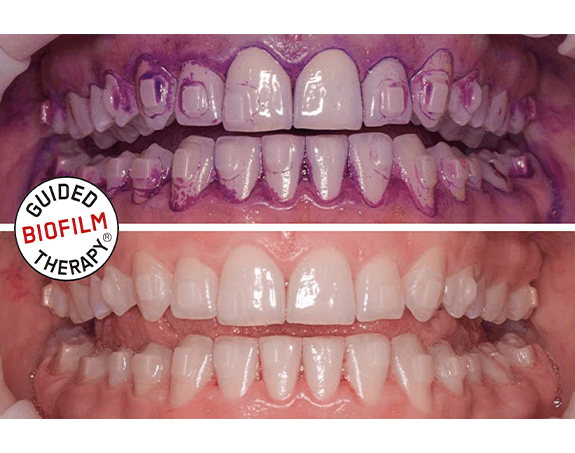Teeth examined with dental mirror