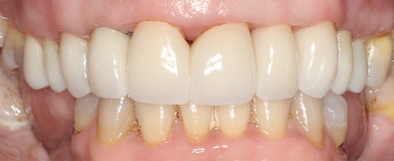 Close up of row of flawless lower teeth with dental crowns