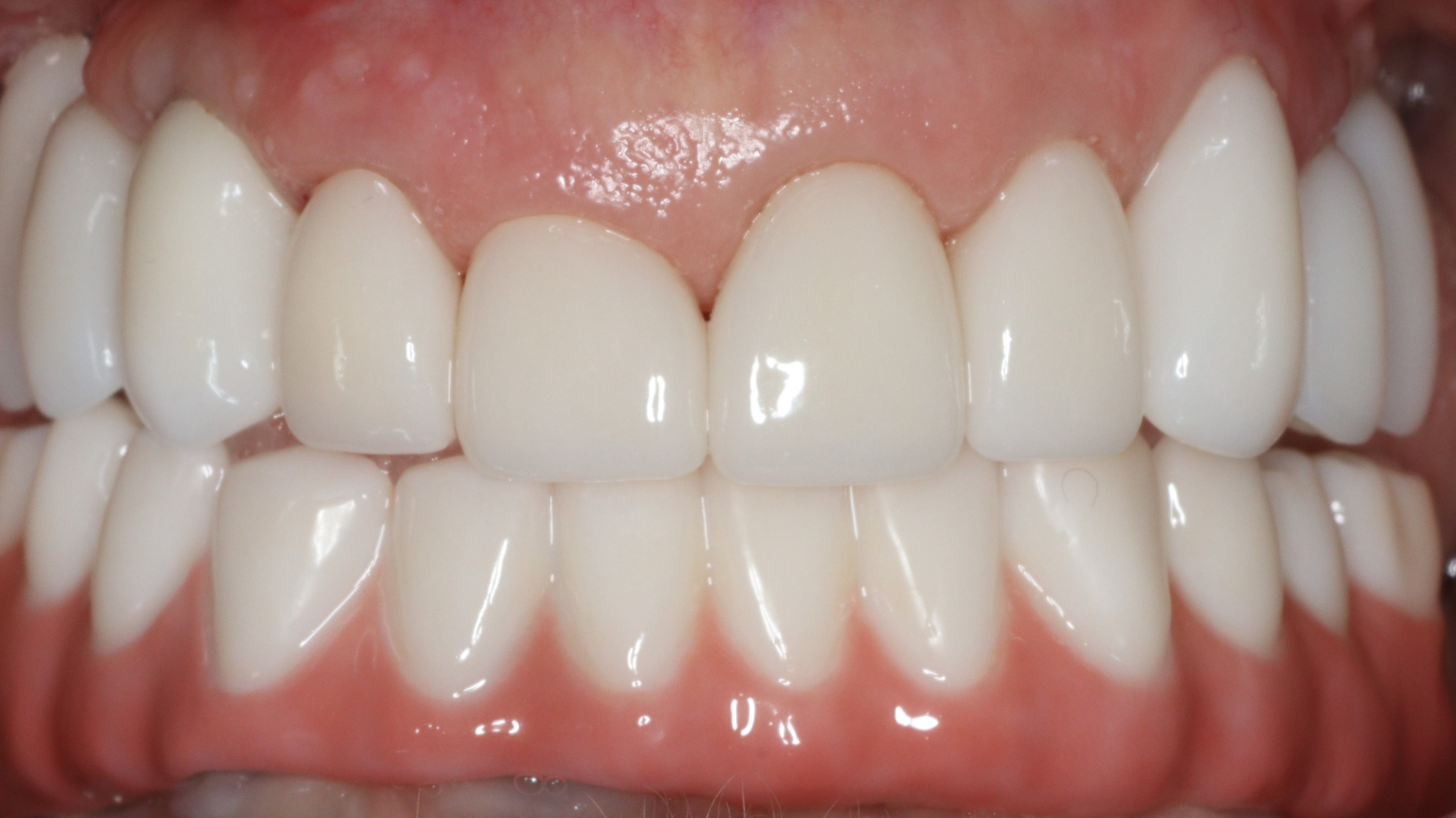 Close up of row of flawless lower teeth with dental crowns