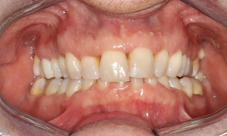 Close up of row of flawed lower teeth