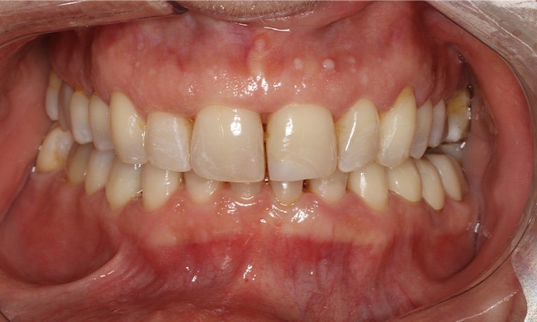 Close up of row of flawless lower teeth with dental crowns