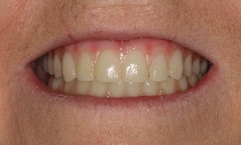 Zoomed in photo of teeth after full mouth transformation