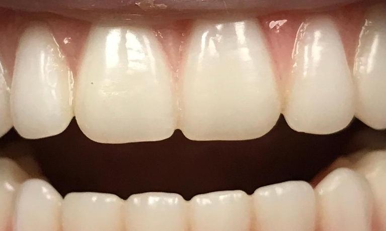 Zoomed in photo of teeth after full mouth transformation