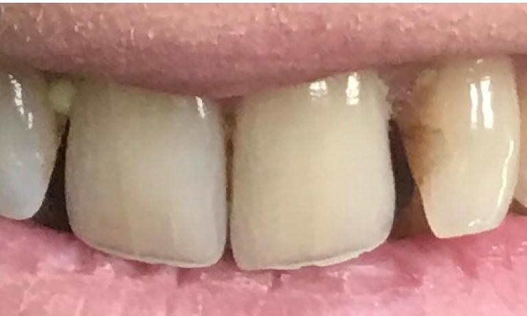 Zoomed in photo of teeth before full mouth transformation