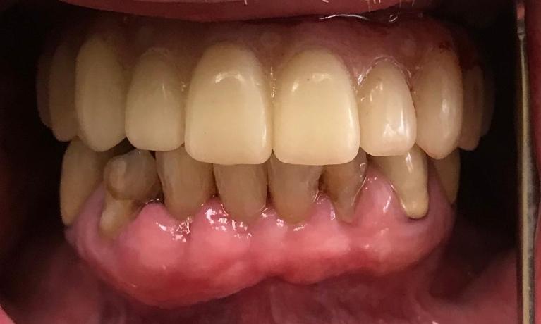 Close up of a complete smile after All on 4 dental implants