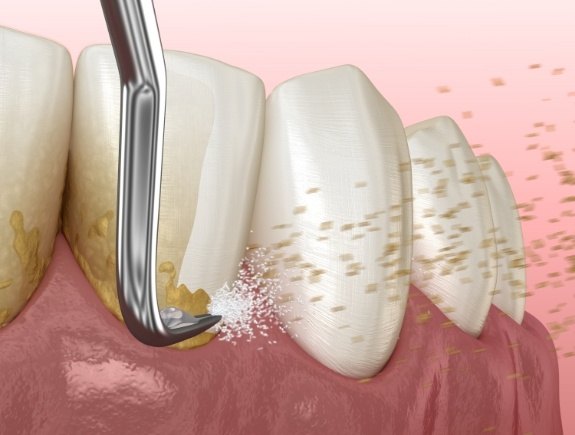 Animated dental tool removing plaque from teeth during gum disease treatment in West Caldwell