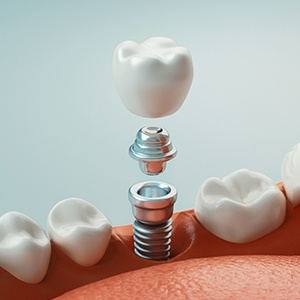 3D render of a dental implant