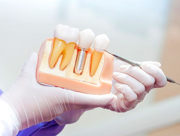 Dentist pointing to a model of a dental implant