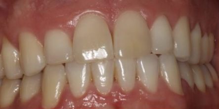 Close up of discolored teeth before dental treatment in West Caldwell
