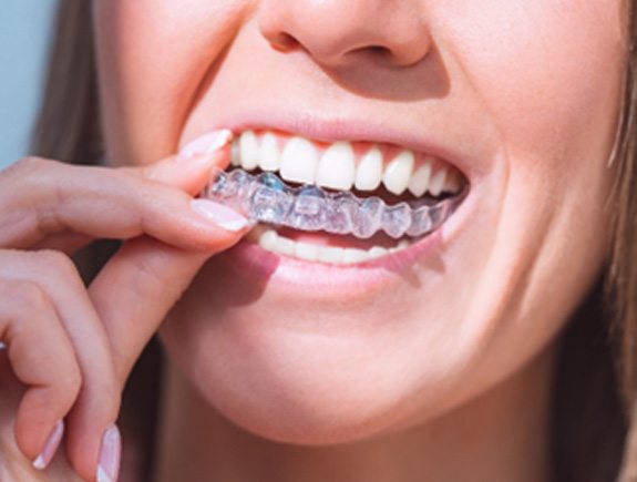 Closeup of patient placing Invisalign aligner on her top teeth