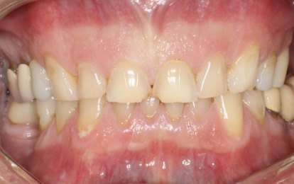 photo of before the smile