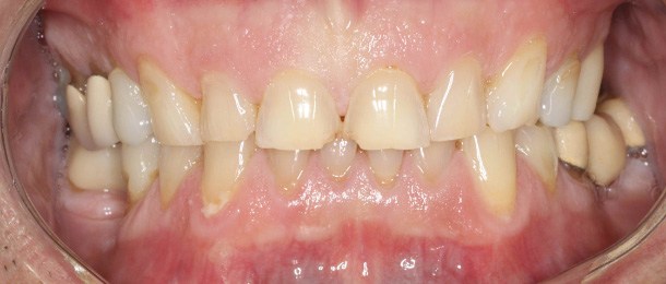 photo of before the smile
