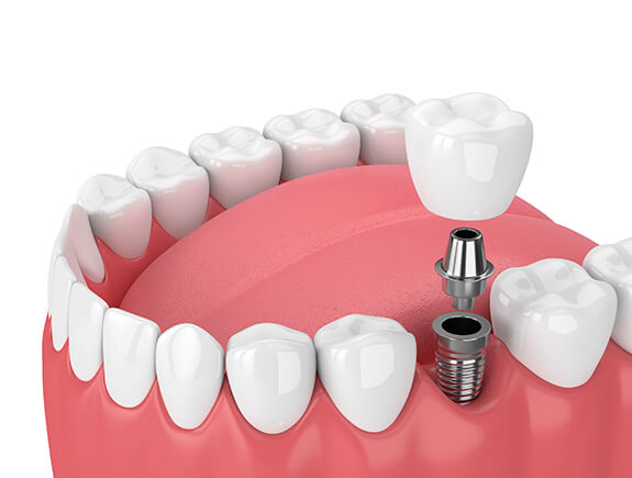 Animated dental implant replacing a missing lower tooth