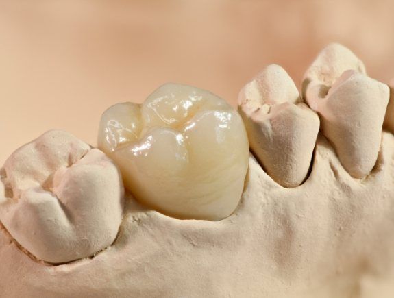 Dental crown in West Caldwell in a model of the lower jaw