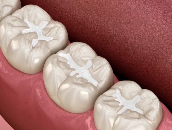 Animated row of teeth with tooth colored fillings in West Caldwell