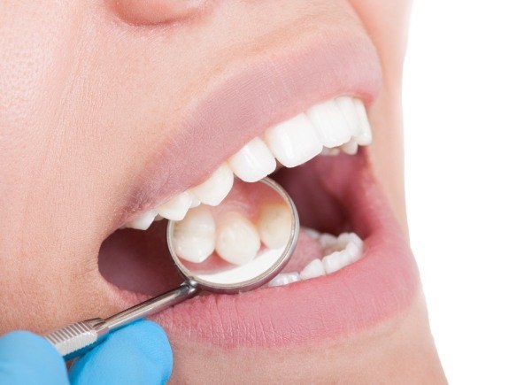 Close up of a dental mirror in a person's mouth