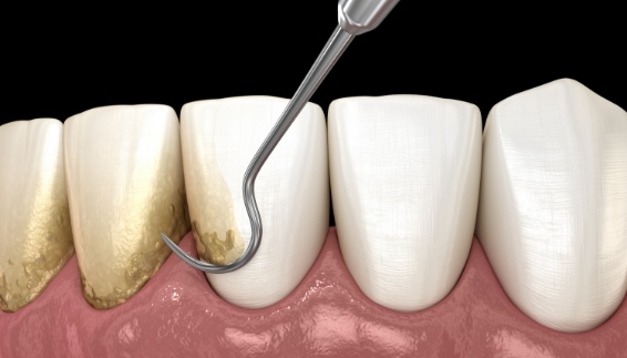 Animated dental instrument scraping plaque buildup off of the teeth