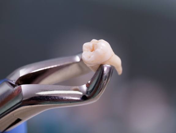 Extracted tooth being held in a pair of dental forceps