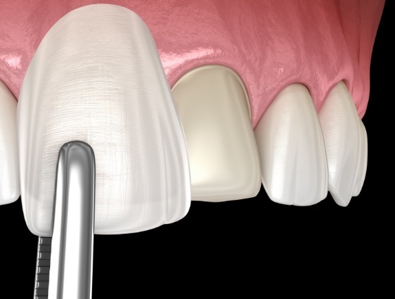 Animated veneer being placed over a tooth